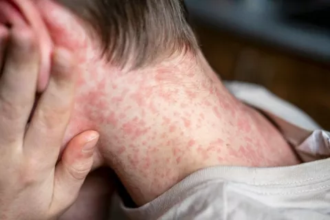 Adolescente con sarpullidos de sarampión en el cuello