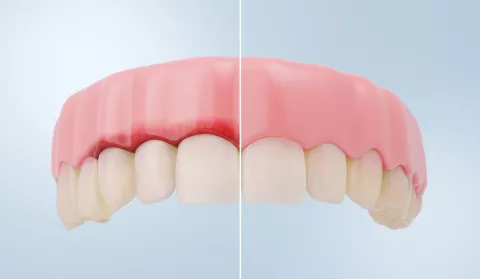 Encías sanas vs gingivitis Comparación de encías sanas vs gingivitis en la representación 3D detallada.