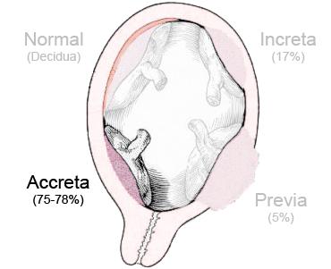 Dibujo de placenta accreta