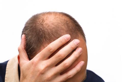 Varón con alopecia areata