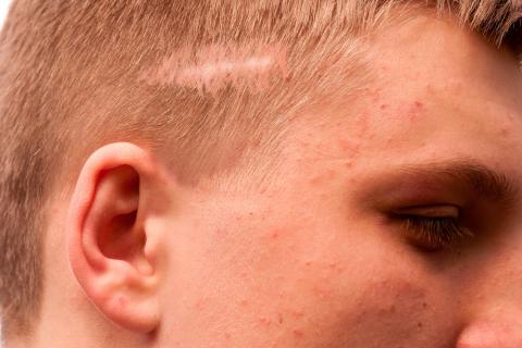 Alopecia cicatrizal