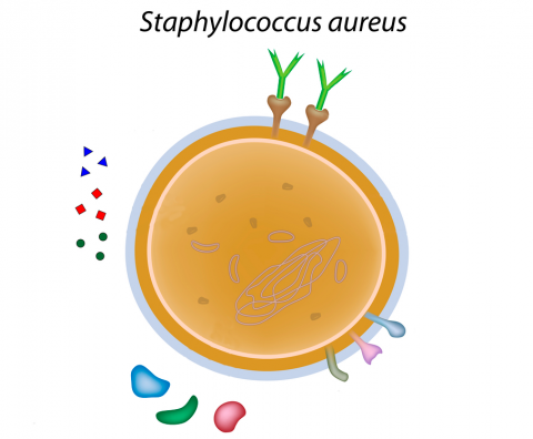 Staphylococcus aureus causa de bronquiectasias