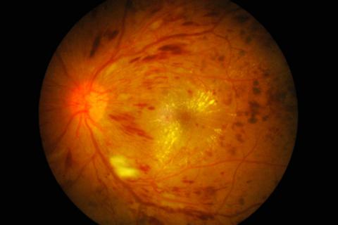 Retina afectada por retinosis pigmentaria