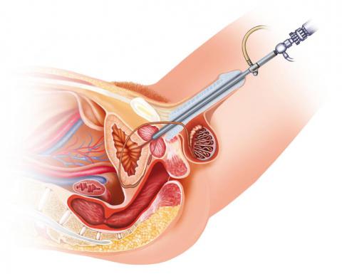 Ilustración del procedimiento de una cistoscopia