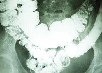 Prueba diagnóstica de la enfermedad de Crohn