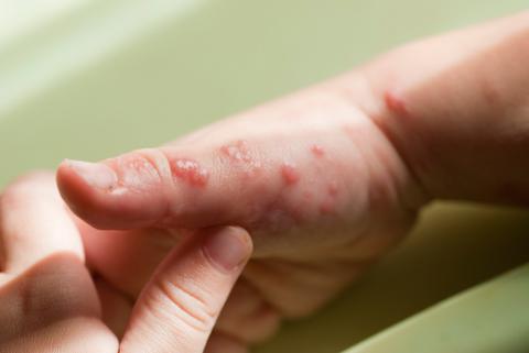 Médico examinando la mano de un niño afectado por el herpes zóster