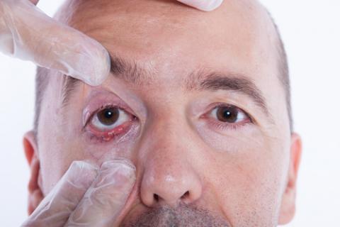 Diagnóstico del ojo seco