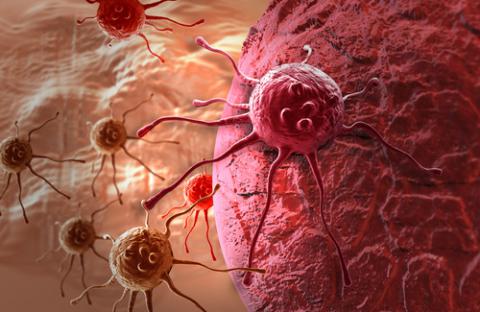 Pronóstico del cáncer de esófago