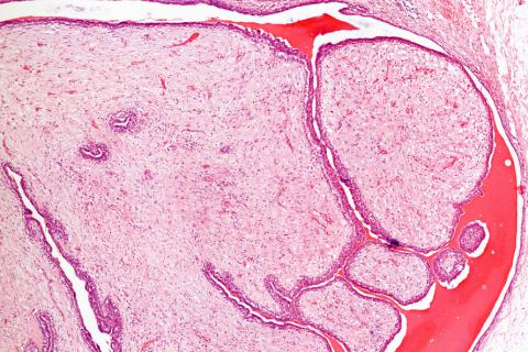 Imagen al detalle de un tumor benigno de la mama