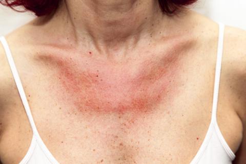 eczema por sol vörös foltok mint anyajegyek a hasán