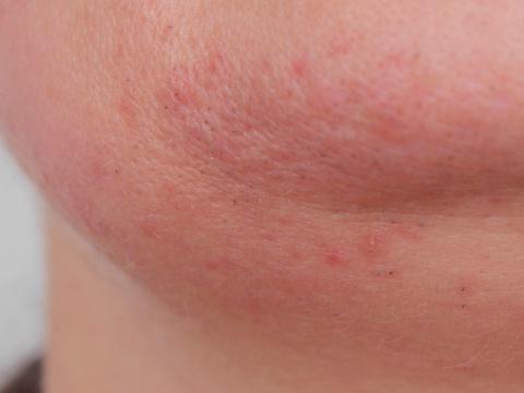 Síntomas de la alergia al huevo en la piel