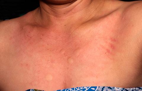 Mujer con dermatitis en el escote por alergia al níquel