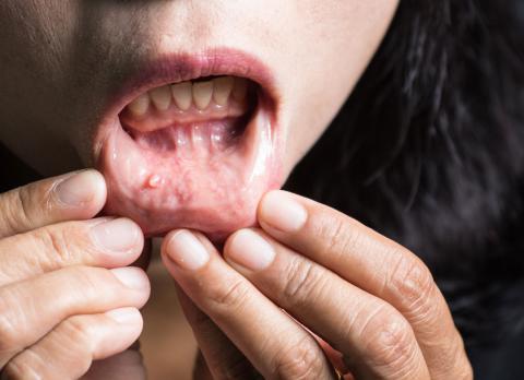 Síntomas del cáncer de la cavidad oral