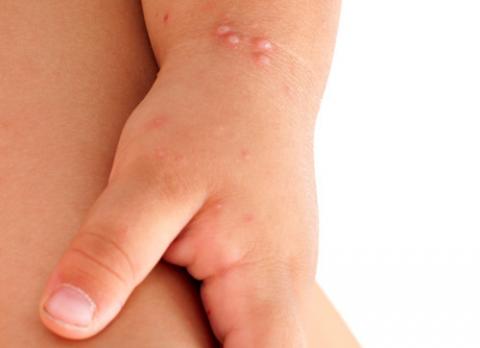 Síntomas del molusco contagioso en la piel