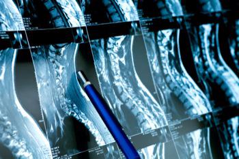 Radiografías para diagnosticar cáncer óseo