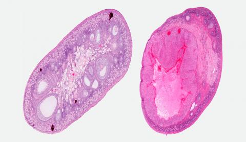 Tipos de cáncer de ovario