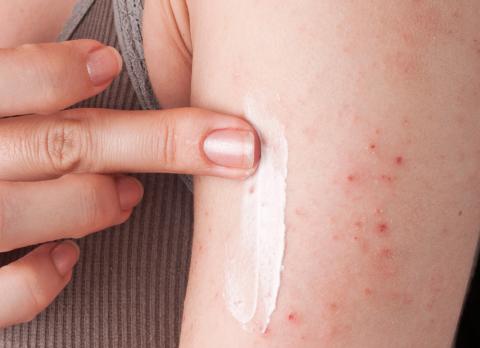 Eczema en un brazo por alergia al níquel