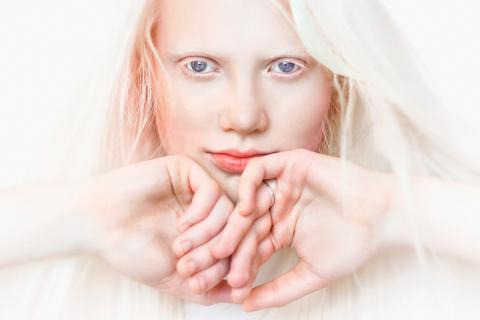Chica con albinismo, sin protección frente al sol