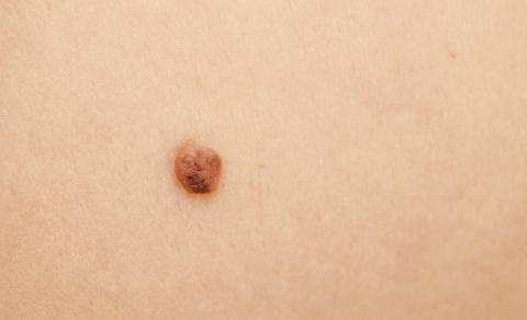 Qué es el cáncer de piel no melanoma