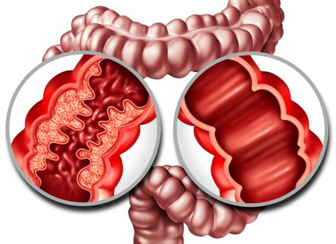 Ilustración de la enfermedad de Crohn