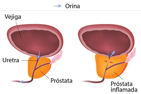 hiperplasia benigna de próstata: síntomas