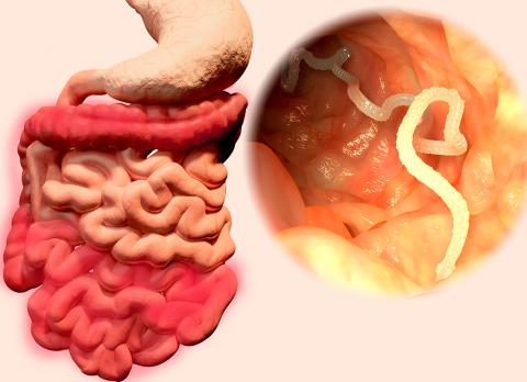 Ilustración de una tenia en el intestino