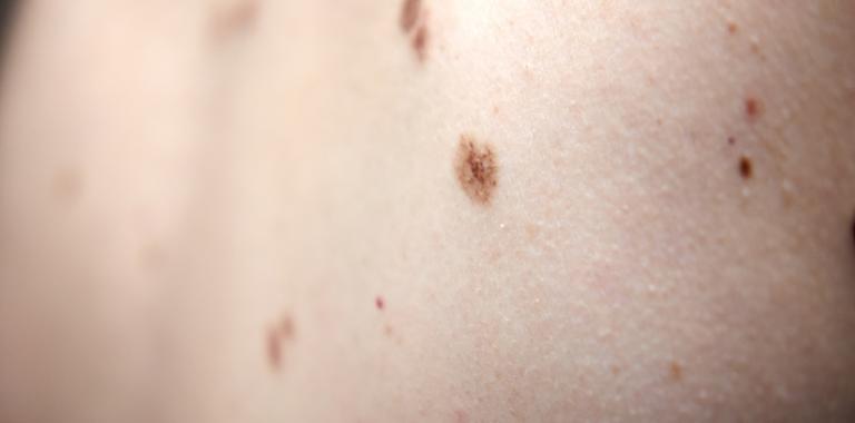 1er paso hacia vacuna para cáncer de piel
