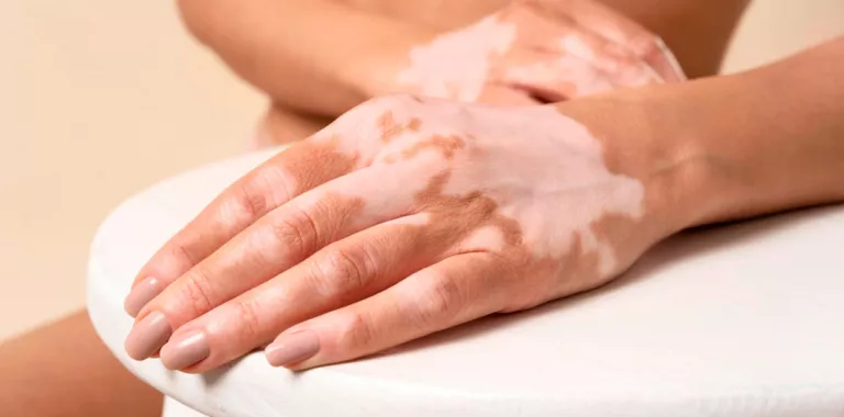 Mujer joven con vitíligo en las manos