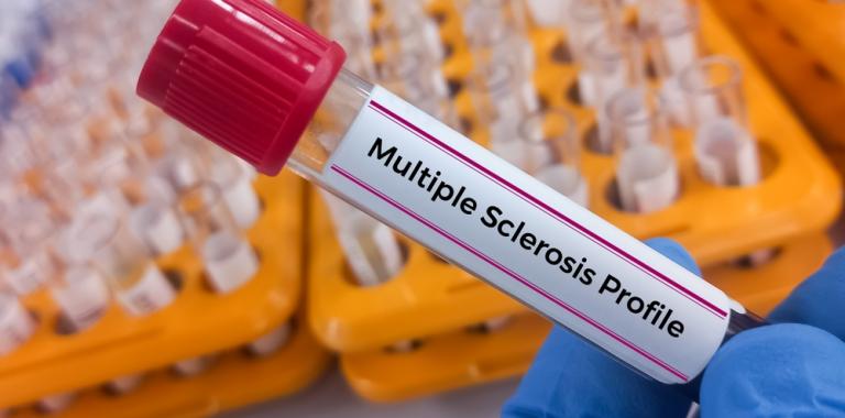 Muestra de sangre para detectar la esclerosis múltiple