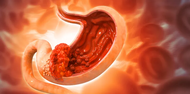 Ilustración de cáncer de estómago o cáncer gástrico
