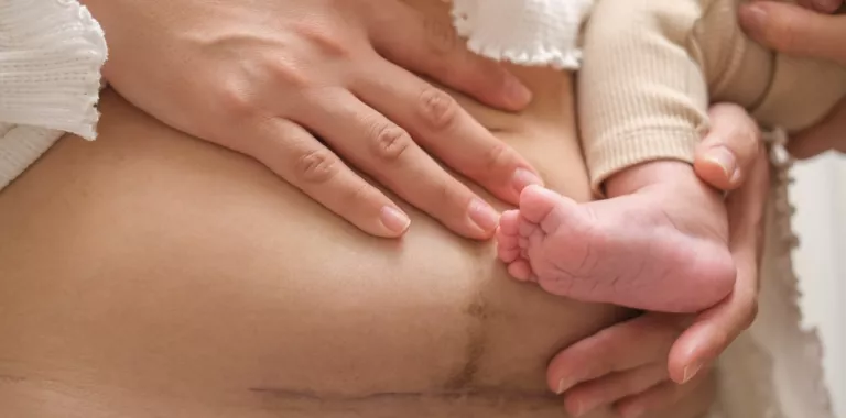 Pierna de bebé se apoya sobre el abdomen de una mujer con cicatriz de cesárea