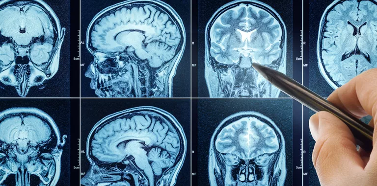 Escáner de un cerebro