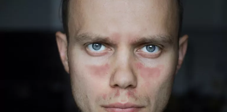 Hombre joven con lesiones rojizas en la piel de la cara