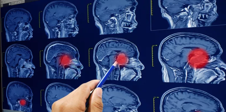 Médico revisa resonancias magnéticas del cerebro y tumores cerebrales
