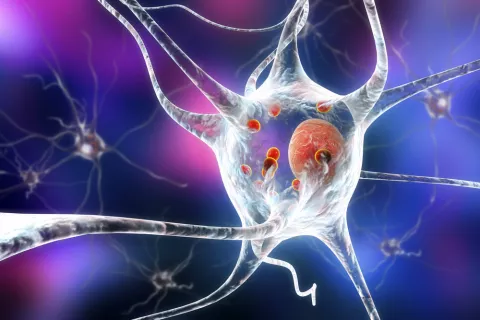 Controlar la neuromelanina podría ayudar a prevenir el párkinson Gráfico de la neuromelanina en el párkinson