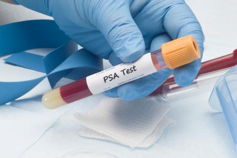 Test para detectar el cáncer de próstata