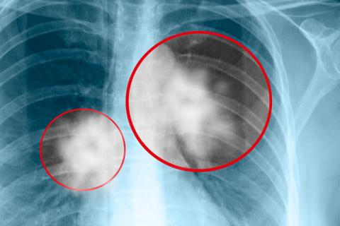 Radiografía de cáncer de pulmón