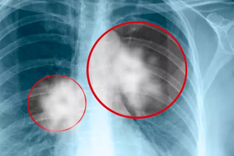 Un nuevo fármaco, eficaz contra un tipo de cáncer de pulmón agresivo Radiografía de cáncer de pulmón