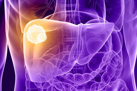 Proteína p38g, nueva diana para tratar el cáncer de hígado Infografía de un cáncer de hígado