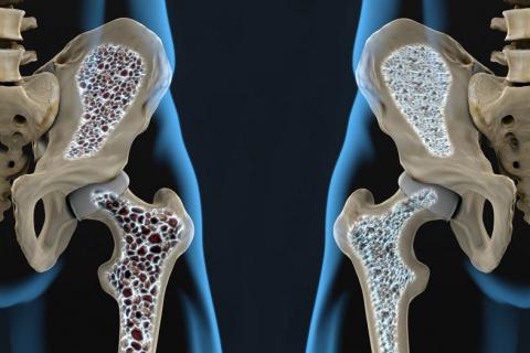 Infografía de una cadera afectada de osteoporosis