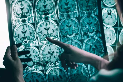 Descubren los tóxicos que causan alzhéimer Médico examinando una resonancia magnética de un cerebro
