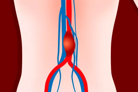 Identifican un posible biomarcador del aneurisma de aorta abdominal Aneurisma de aorta abdominal