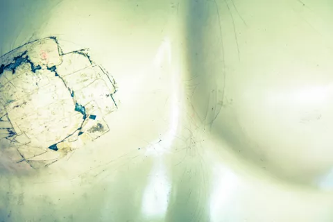 Una terapia que frena el cáncer de mama metastásico llega a España Cáncer de mama metastásico