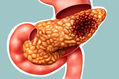 Una nueva terapia retrasa la progresión del cáncer de páncreas Cáncer de páncreas