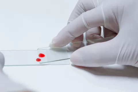 Una nueva técnica detecta el VIH con solo dos gotas de sangre seca Nueva técnica que detecta el VIH con dos gotas de sangre seca
