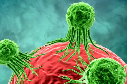Detectan el proceso molecular que desencadena la metástasis del cáncer Metástasis del cáncer