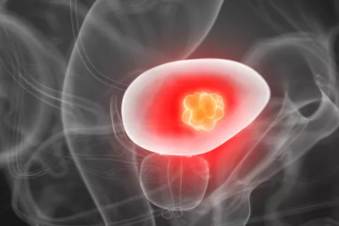 Un tratamiento combinado logra remitir el cáncer de vejiga en ratones Un tratamiento combinado para remitir el cáncer de vejiga en ratones