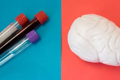 Medir el beta amiloide en sangre predice signos tempranos de alzhéimer Análisis de sangre para detectar el alzhéimer