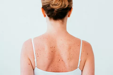Nueva terapia combinada para tratar el melanoma, disponible en España Nueva terapia para tratar el melanoma