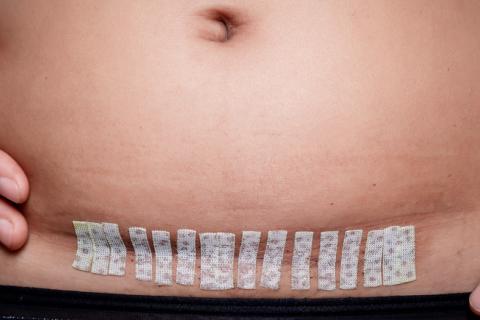 El parto por cesárea puede influir en la flora intestinal del bebé 